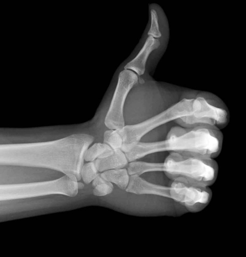 XRAY_Thumb
